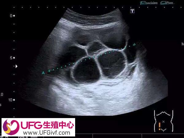 移植完胚胎后为什么腹水